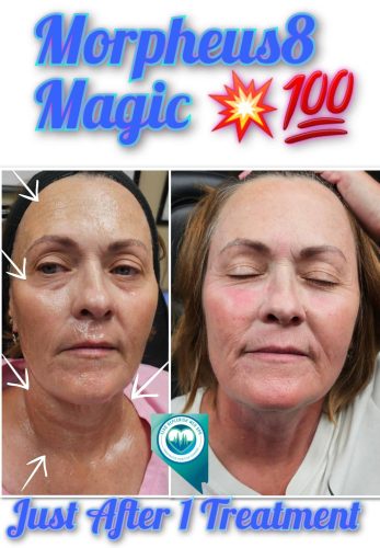 Mprpheus8 Treatment Before and After Images | Elko Replenish Med Spa | Elko, NV