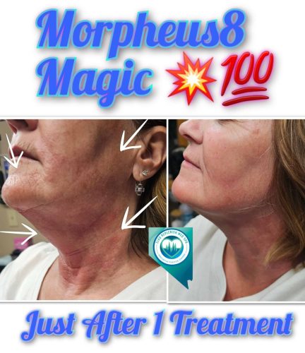 Mprpheus8 Treatment Before and After Images | Elko Replenish Med Spa | Elko, NV