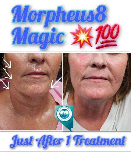 Mprpheus8 Treatment Before and After Images | Elko Replenish Med Spa | Elko, NV