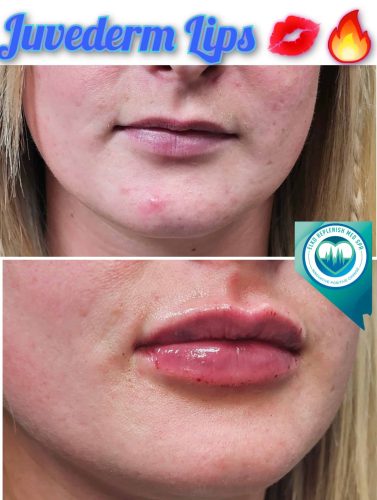 Juvederm lips Before and After Images | Elko Replenish Med Spa | Elko, NV