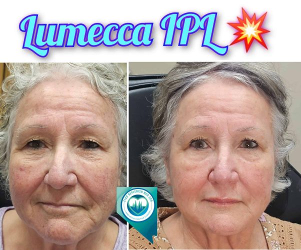 Lumecca IPL Before and After Images 4 | Elko Replenish Med Spa | Elko, NV