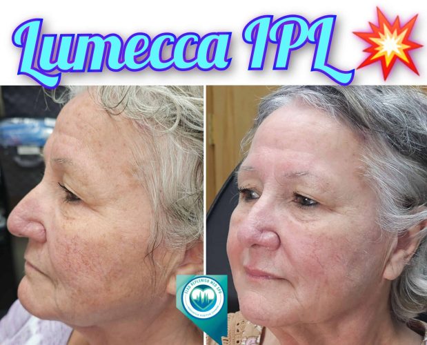 Lumecca IPL Before and After Images 8 | Elko Replenish Med Spa | Elko, NV