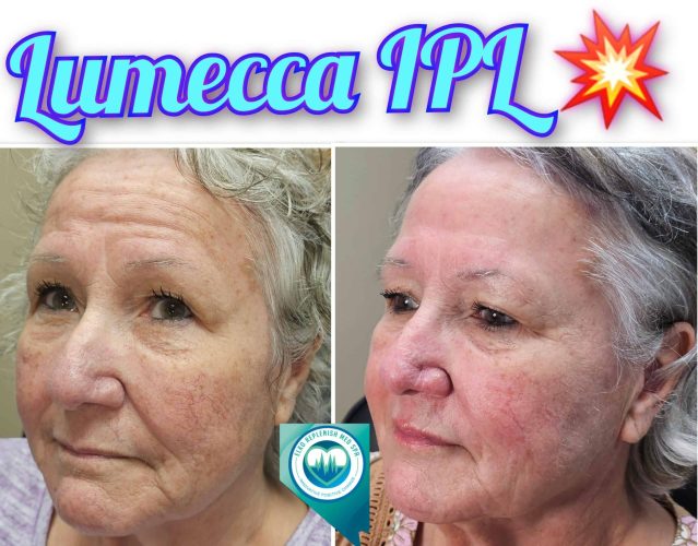 Lumecca IPL Before and After Images 5 | Elko Replenish Med Spa | Elko, NV