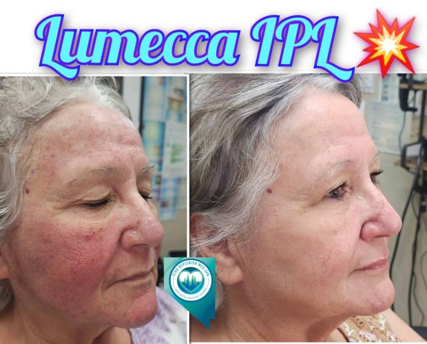 Lumecca IPL Before and After Images 2 | Elko Replenish Med Spa | Elko, NV