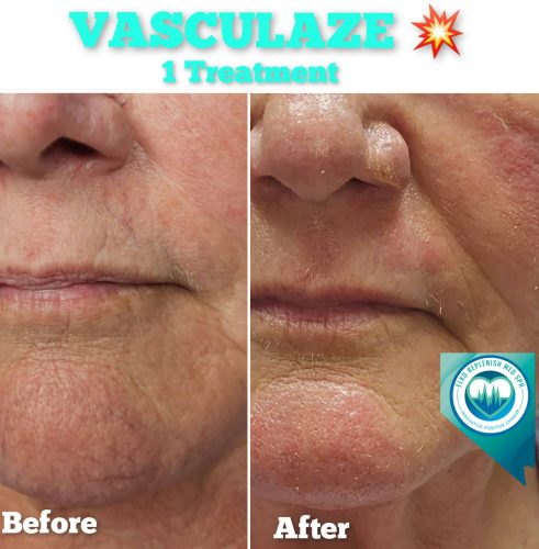 Vasculaze Before and After Images | Elko Replenish Med Spa | Elko, NV