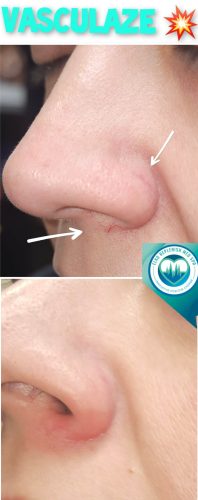 Vasculaze Before and Images | Elko Replenish Med Spa | Elko, NV