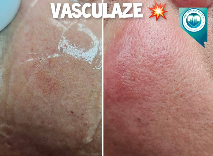 Vasculaze Treatment Before and After Images | Elko Replenish Med Spa | Elko, NV