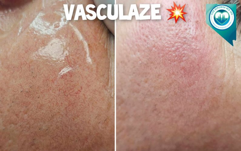 Vasculaze Before and After Images | Elko Replenish Med Spa | Elko, NV