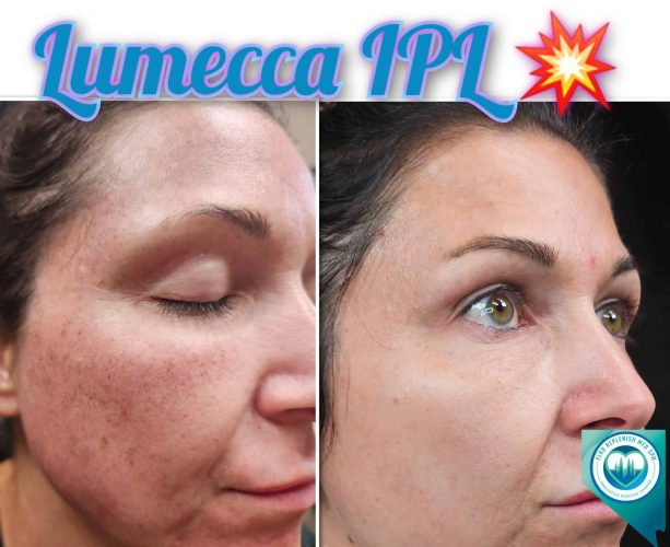 Lumecca IPL Before and After Images 3 | Elko Replenish Med Spa | Elko, NV