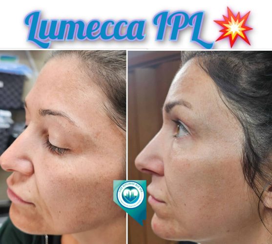 Lumecca IPL Before and After Images 3 | Elko Replenish Med Spa | Elko, NV