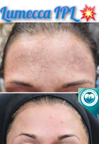 Lumecca IPL Before and After Images | Elko Replenish Med Spa | Elko, NV