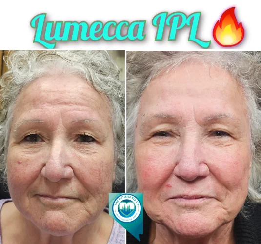 Lumecca IPL Treatment before and after images 18 | Elko Replenish Med Spa | Elko, NV