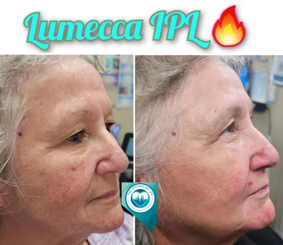 Lumecca IPL Treatment before and after images 15 | Elko Replenish Med Spa | Elko, NV