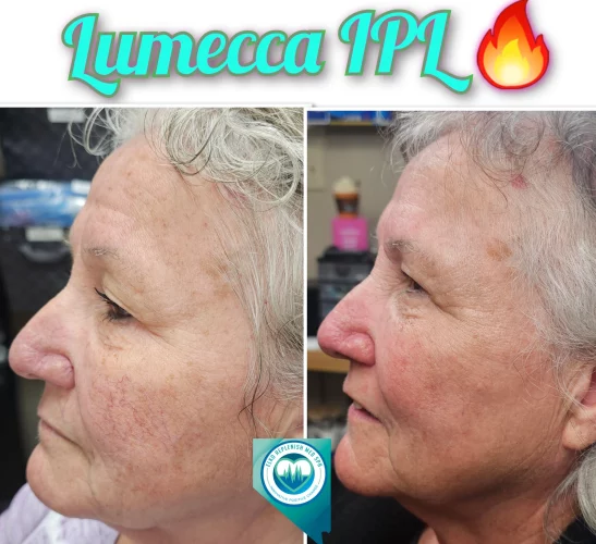 Lumecca IPL Treatment before and after images 17 | Elko Replenish Med Spa | Elko, NV