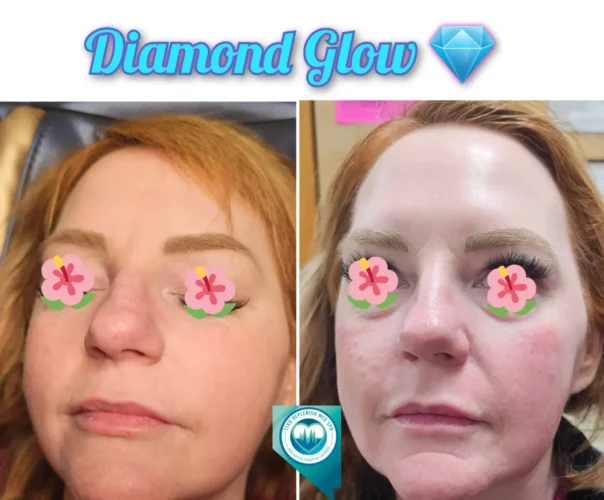 Diamond Glow | Face | Elko Replenish Med Spa | Elko, NV