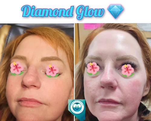 Diamond Glow | Face | Elko Replenish Med Spa | Elko, NV