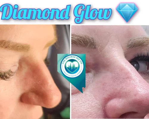 Diamond Glow | Elko Replenish Med Spa | Elko, NV