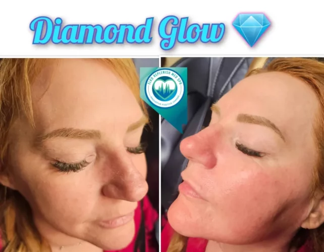 Diamond Glow Facial | Elko Replenish Med Spa | Elko, NV