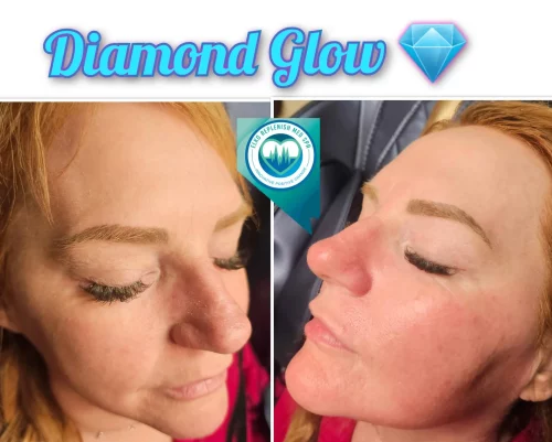 Diamond Glow Facial | Elko Replenish Med Spa | Elko, NV