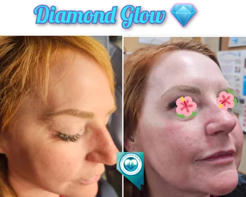 Diamond Glow For Face | Elko Replenish Med Spa | Elko, NV