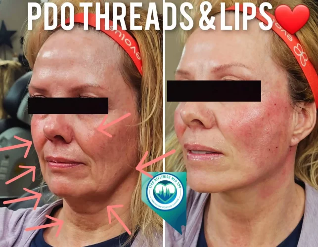 PDO Threads & Lips Treatment | Elko Replenish Med Spa | Elko, NV