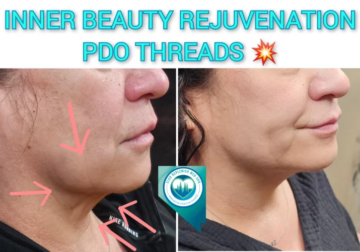 PDO threads before and after images 3 | Elko Replenish Med Spa | Elko, NV