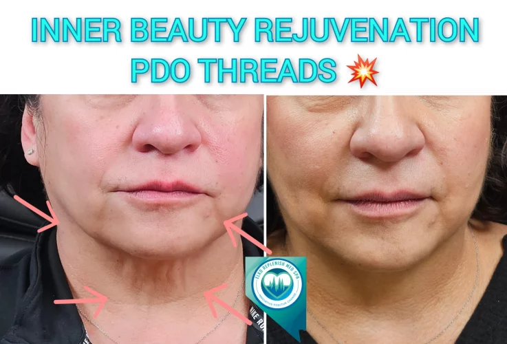 PDO threads before and after images 2 | Elko Replenish Med Spa | Elko, NV