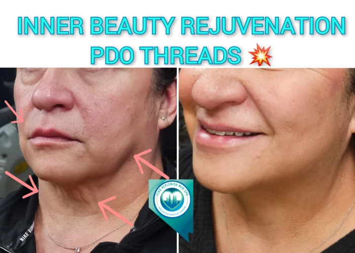 PDO threads before and after images 1 | Elko Replenish Med Spa | Elko, NV