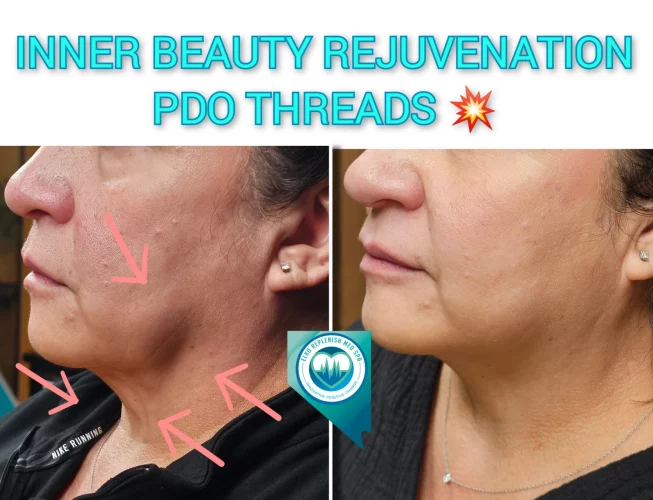 PDO threads before and after images | Elko Replenish Med Spa | Elko, NV