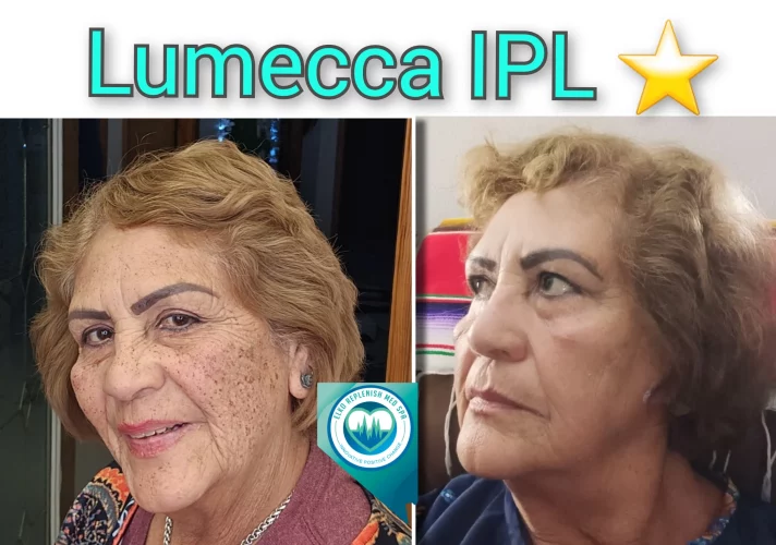 Lumecca IPL Treatment before and after images 14 | Elko Replenish Med Spa | Elko, NV