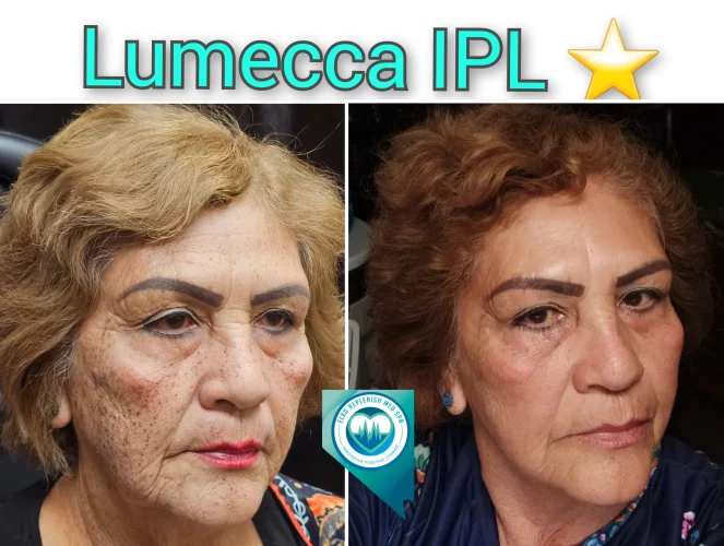 Lumecca IPL Treatment before and after images 13 | Elko Replenish Med Spa | Elko, NV