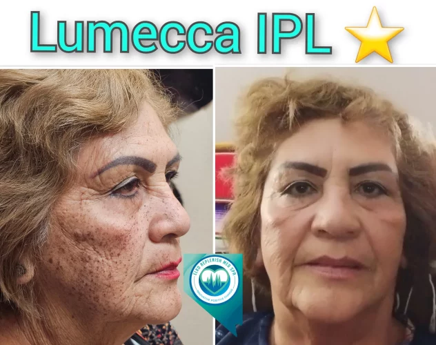 Lumecca IPL Treatment before and after images 12 | Elko Replenish Med Spa | Elko, NV