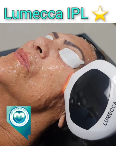 Lumecca IPL Treatment | Elko Replenish Med Spa | Elko, NV