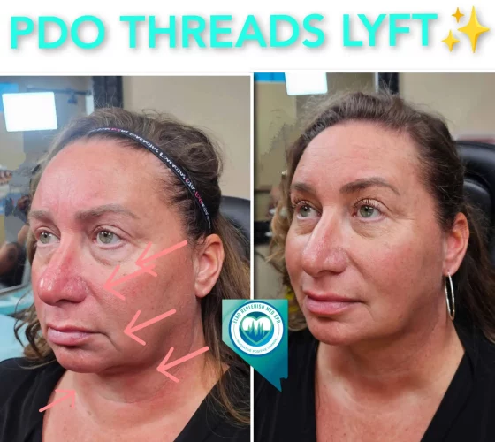 PDO Threads LYFT | Elko Replenish Med Spa | Elko, NV