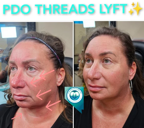 PDO threads LYFT before and after images 3 | Elko Replenish Med Spa | Elko, NV