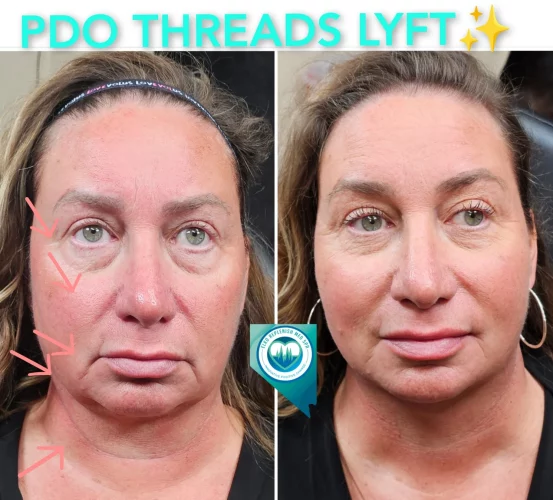 PDO threads LYFT before and after images 2 | Elko Replenish Med Spa | Elko, NV