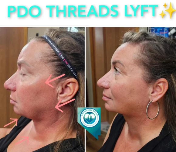 PDO Threads Transformation | Elko Replenish Med Spa | Elko, NV