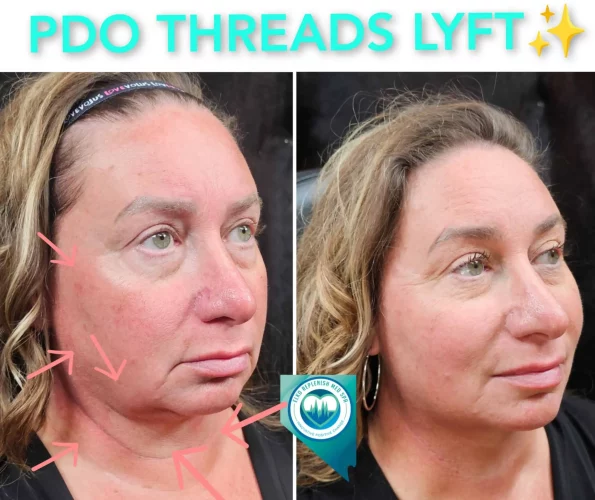 PDO Threads LYFT Rejuvenation | Elko Replenish Med Spa | Elko, NV