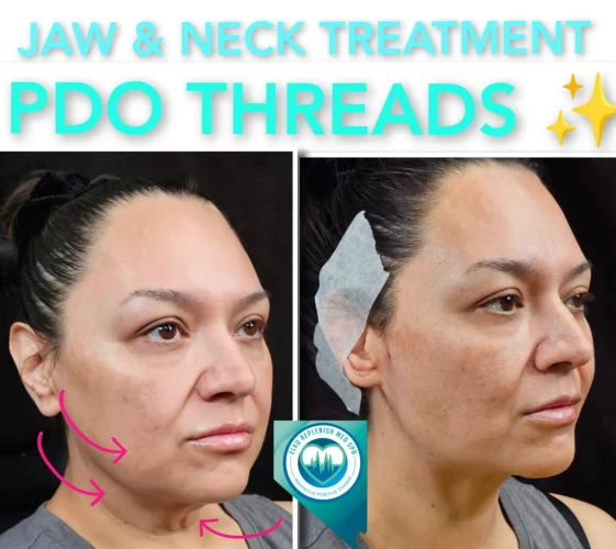 Jaw & Neck Treatment PDO threads before and after images 4 | Elko Replenish Med Spa | Elko, NV