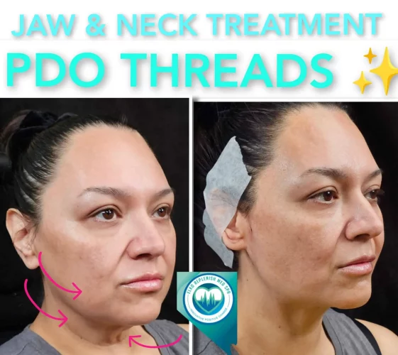 Jaw Treatment with PDO Threads | Elko Replenish Med Spa | Elko, NV