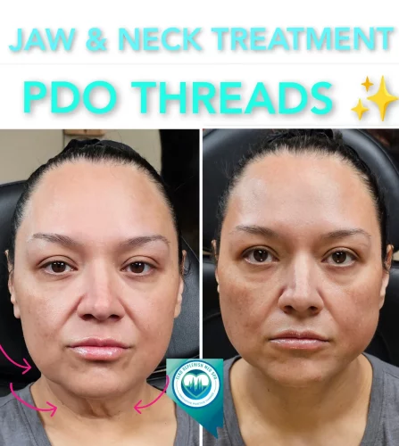 Jaw & Neck Treatment PDO threads before and after images 3 | Elko Replenish Med Spa | Elko, NV