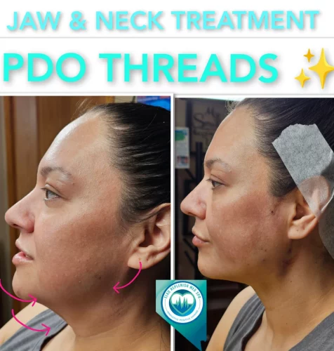 Jaw & Neck Treatment PDO threads before and after images 2 | Elko Replenish Med Spa | Elko, NV