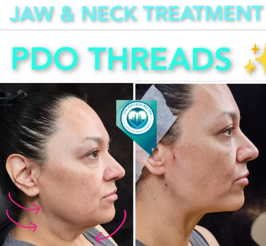 Jaw & Neck Treatment PDO threads before and after images 1 | Elko Replenish Med Spa | Elko, NV