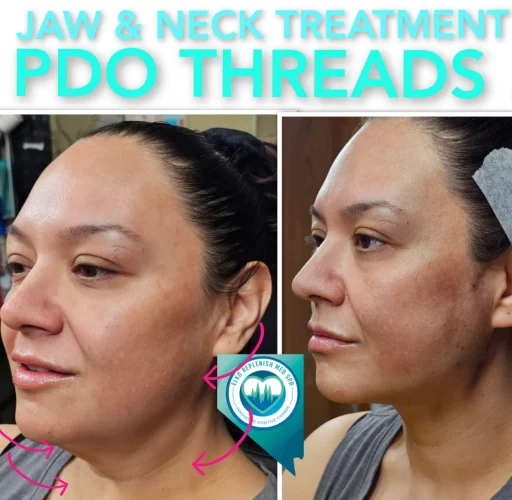 Jaw & Neck Treatment PDO threads before and after images | Elko Replenish Med Spa | Elko, NV