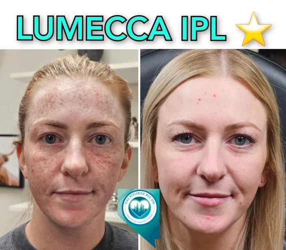 Lumecca IPL Treatment before and after images 11 | Elko Replenish Med Spa | Elko, NV