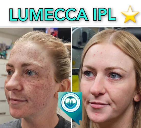 Lumecca IPL Treatment before and after images 10 | Elko Replenish Med Spa | Elko, NV