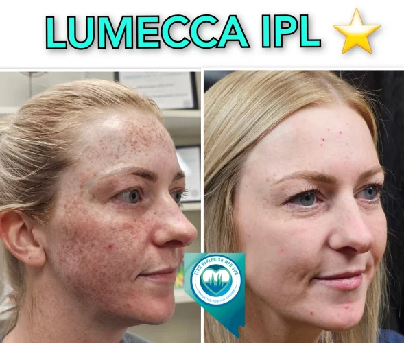 Lumecca IPL Treatment before and after images 9 | Elko Replenish Med Spa | Elko, NV