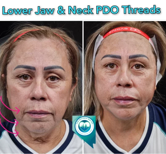 Lower Jaw & Neck PDO threads before and after images 1 | Elko Replenish Med Spa | Elko, NV