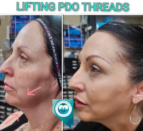 PDO thread lifting before and after showing improved facial definition in Elko, NV .