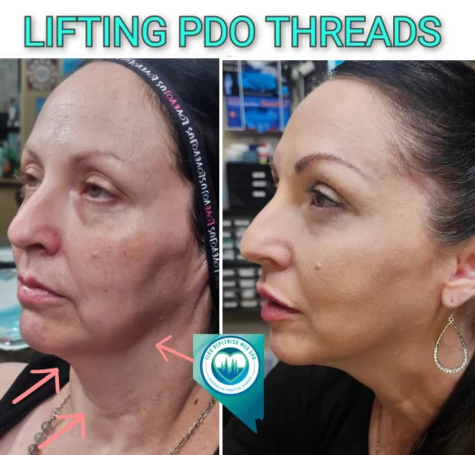 Before and after PDO thread lifting results in Elko, NV showing enhanced facial definition.